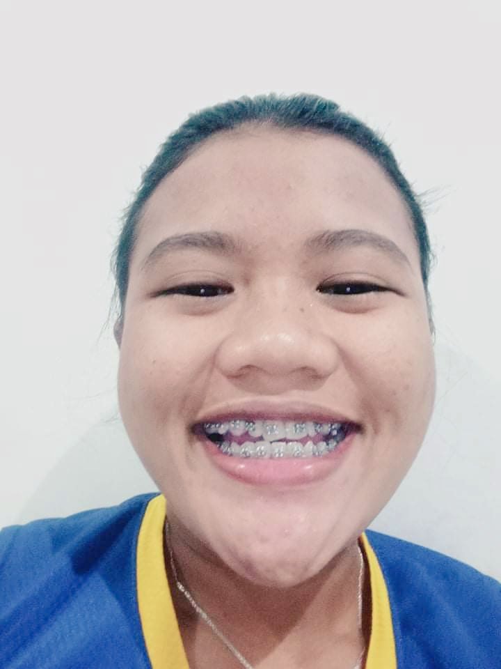 _arliee's tweet photo. Before and After HAHAHAHA Thanksss Doc after 3years naka graduate nagyud sa braces 🫶 https://t.co/9vz4GjNej8