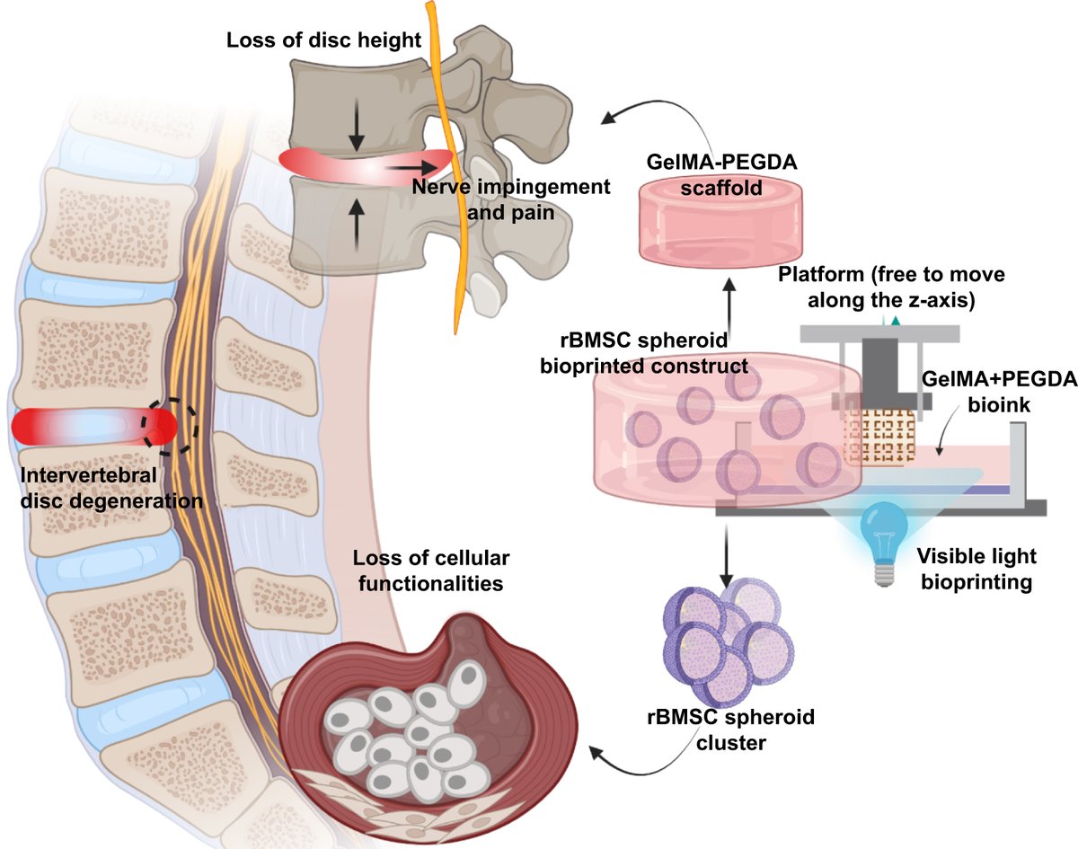 IntJExtremManuf's tweet photo. 💫Visible light-induced 3D bioprinting of mesenchymal stem cell spheroids facilitates the creation of composite scaffolds for comprehensive intervertebral disc (IVD) repair.

Open Access #IJEM👉: https://t.co/9odyAuWhGb

#ExtremeManufacturing #AddictiveManufacturing #Bioprinting https://t.co/hk4AgOxFRH