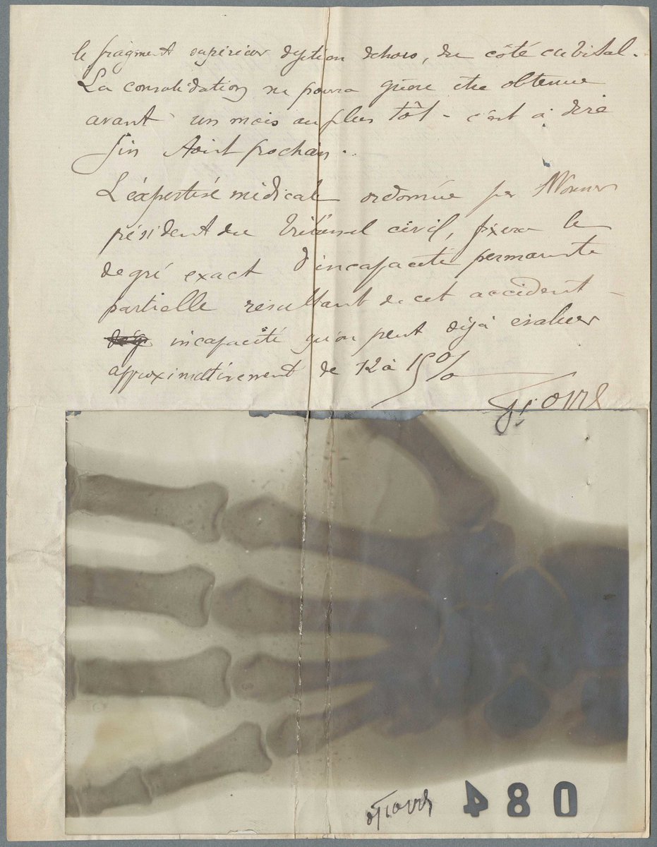 Une reconnaissance de handicap pour un travailleur, datant de 1908 !

Une archive médicale magnifique partagée par les Archives départementales de la Loire (oui le post date un peu, mais tellement incroyable !) 
#archivesmedicales #handicap #ancêtres #genealogie

cote 3u3_1438