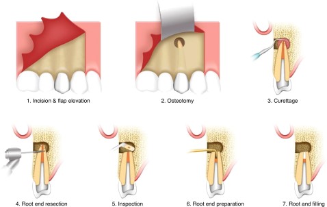 transpread's tweet image. The International Journal of Oral Science published an expert consensus that provides a detailed guide to apical microsurgery.
#Pulpitis #Reconstruction
Details: doi.org/10.1038/s41368…