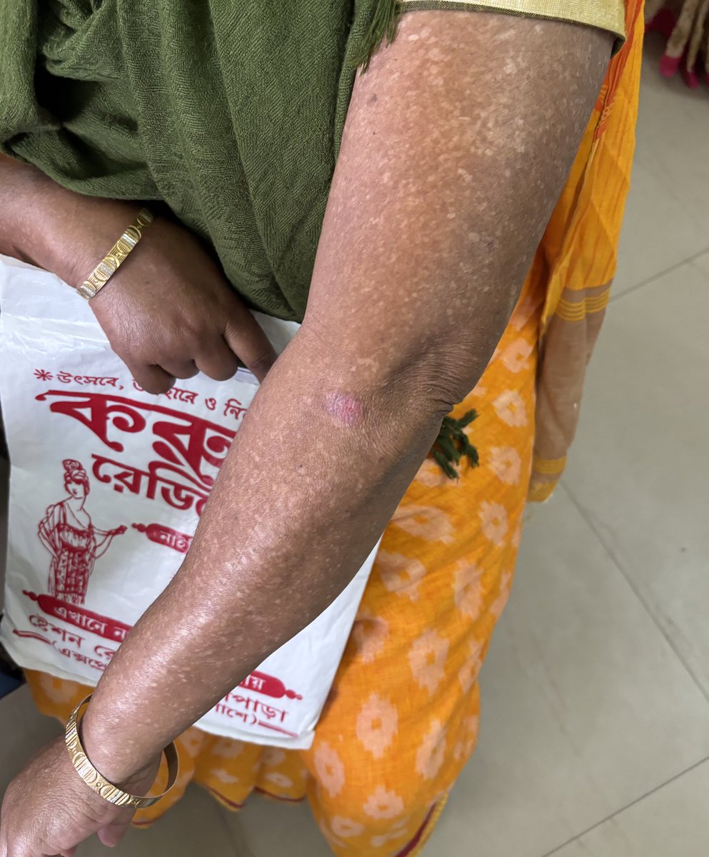 iv_dopamine's tweet photo. Characteristic pigmentation due to chronic consumption of water with increased levels of a particular element  in this patient. Can you name the pigmentation pattern and the element in question?
#medtwitter #medX https://t.co/Z3QObro4mq