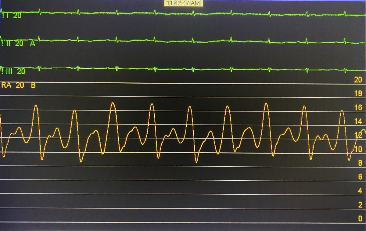 DrRajeshG1's tweet photo. Quiz for fellows. RA tracing of a patient with HOCM. What is the observation and what you call it? https://t.co/7e0WjjjASd