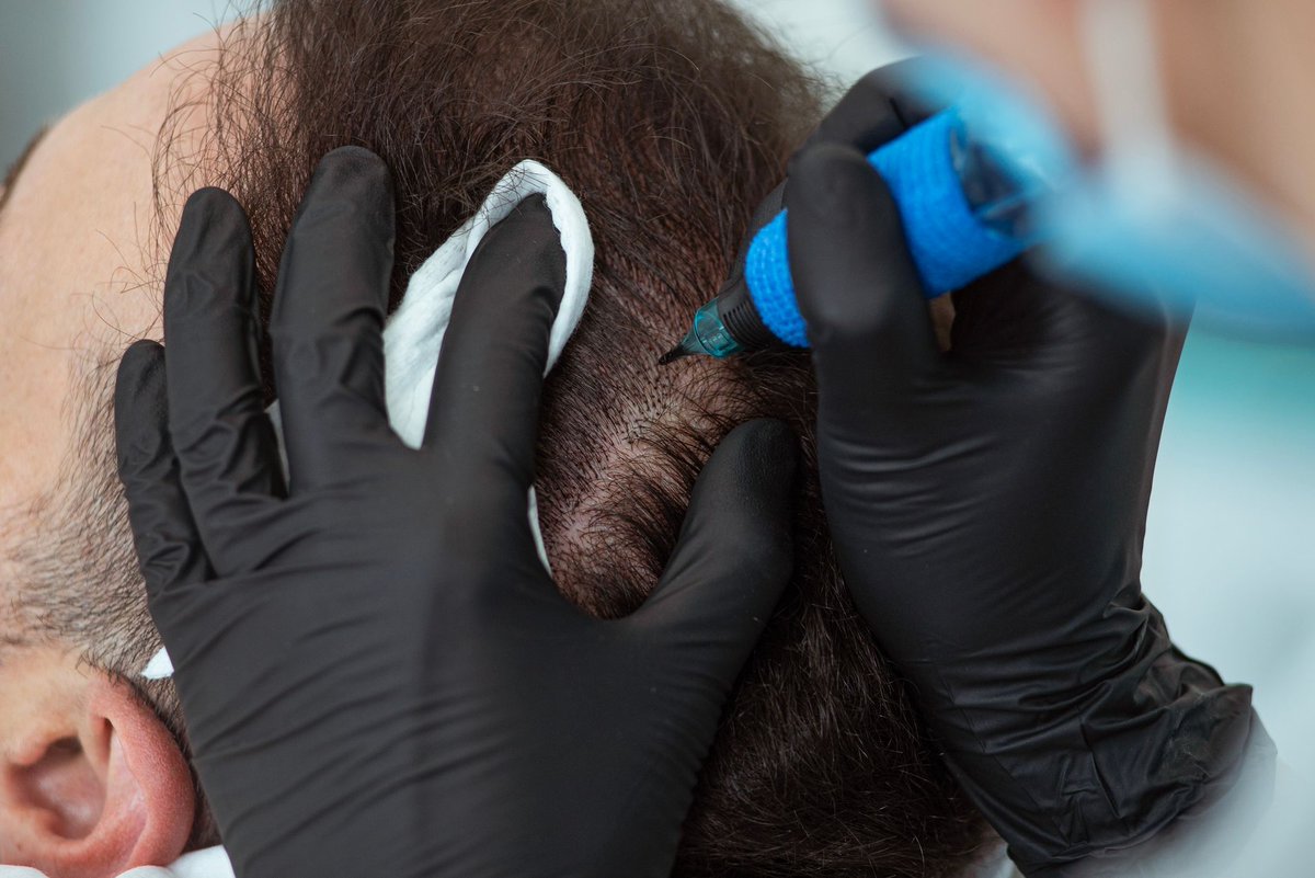 wmglondon's tweet image. SMP treatment is an innovative, non-surgical hair loss solution, performed at our Harley Street clinic in London.

Contact Westminster Medical Group for more information.

Click 👉 wmglondon.com

#scalpmicropigmentation #scalppigmentation #hairloss