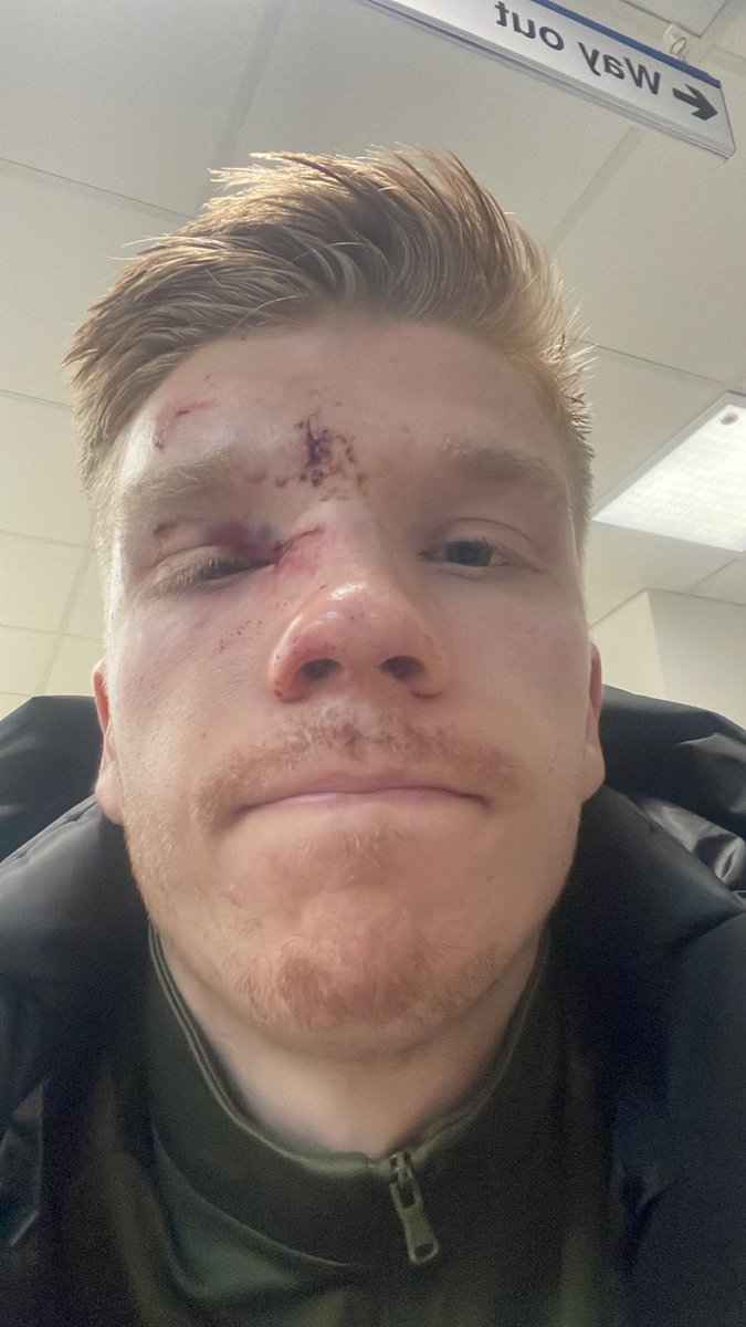 Player Update!

Sadly, our goalkeeper Jacob Russell sustained injuries during last night’s match, including stitches to wounds on his head and near his eye, as well as a broken nose. Thankfully, there’s no damage to his eye or socket. Everyone at Faversham Town wishes Jacob a