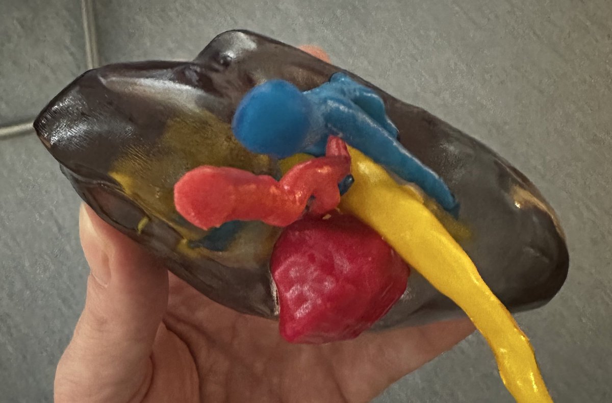 Challenging cases today 🤓#robotic  level 2 vena cava thrombus #kidneycancer &amp; posterior hilar #robotic partial nephrectomy. Thanks you Jean-Christophe Bernhard <a href="/uroccr/">UroCCR</a> for paving the way 🙏🏻 <a href="/WaeckelT/">Waeckel Thibaut</a> @chu_caen