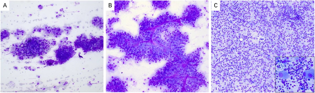 New this week! Cytologic diagnosis of fumarate hydratase-deficient renal cell carcinoma: A single-institutional experience

acsjournals.onlinelibrary.wiley.com/doi/10.1002/cn…

<a href="/Alaricelowe/">Ali Lowe</a> <a href="/pcmullane/">Patrick Mullane</a> <a href="/HubertLauMD/">Hubert Lau</a> <a href="/md_qian/">Xiaohua Qian, MD</a> <a href="/StanfordPath/">Stanford Pathology</a> #CytoPath