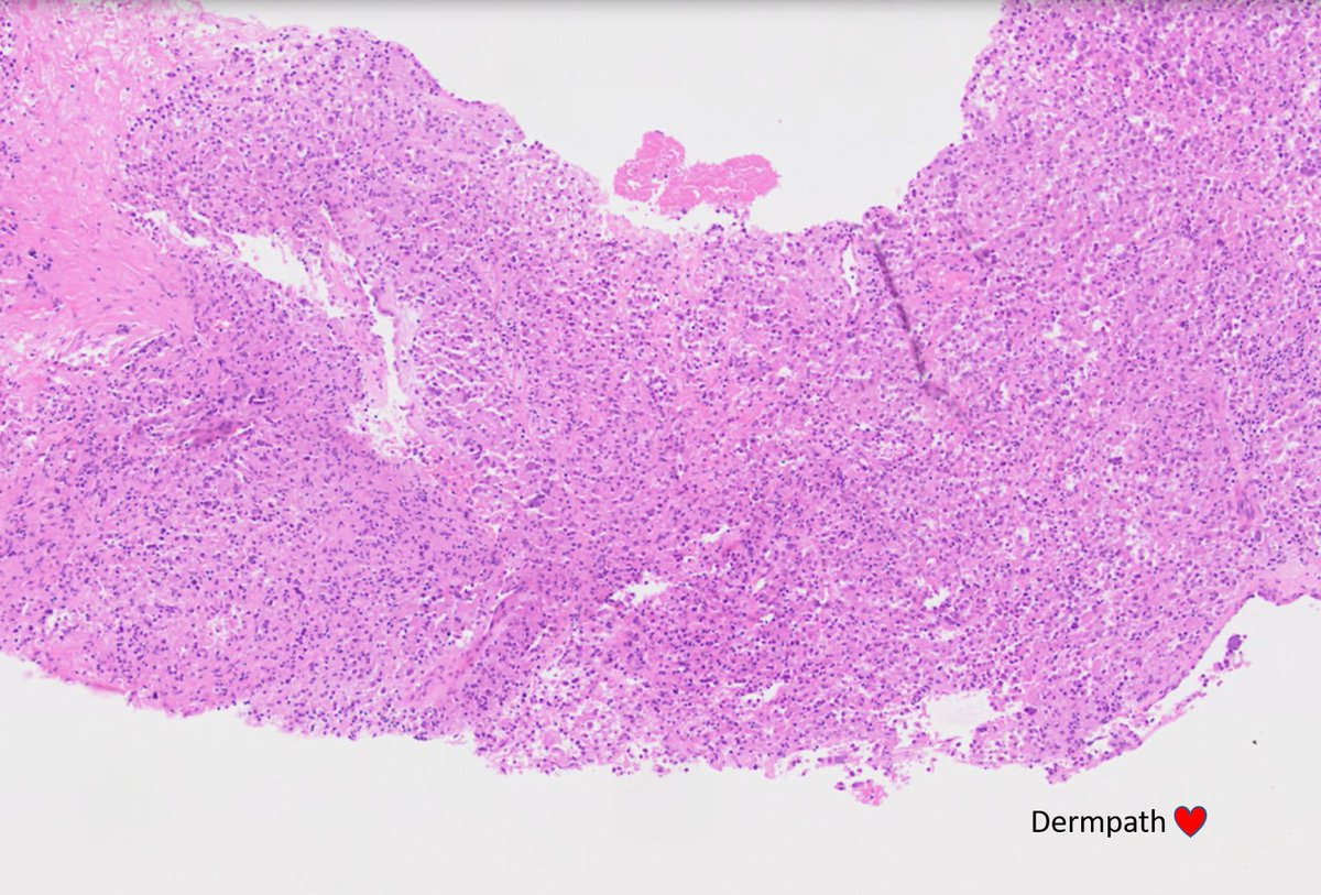 DermpathLove's tweet photo. F, 30s, deep soft tissue mass - cbx. Lung mets at presentation. Dx, diffs? #bstpath https://t.co/BUOj8zNvp3