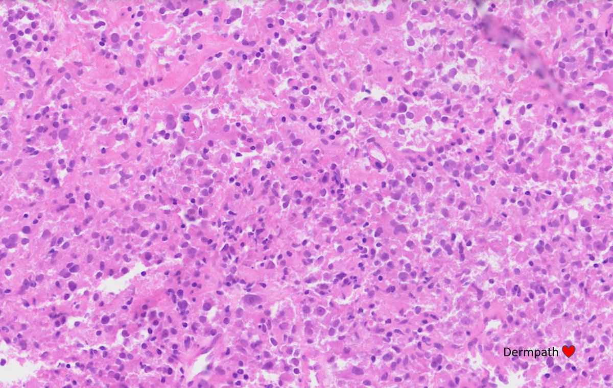 DermpathLove's tweet photo. F, 30s, deep soft tissue mass - cbx. Lung mets at presentation. Dx, diffs? #bstpath https://t.co/BUOj8zNvp3
