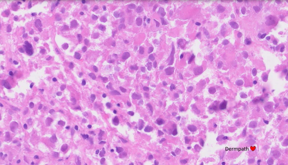 DermpathLove's tweet photo. F, 30s, deep soft tissue mass - cbx. Lung mets at presentation. Dx, diffs? #bstpath https://t.co/BUOj8zNvp3