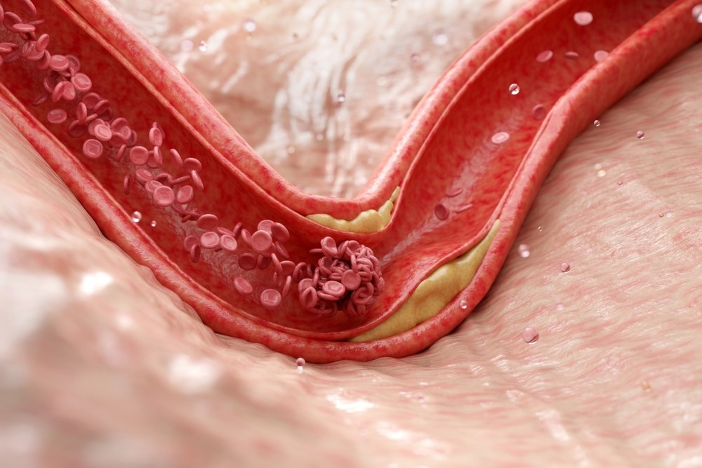 NewsMedical's tweet photo. Researchers identify a natural defense against blood vessel inflammation and atherosclerosis
Read more: https://t.co/Bipb5SBzj1
#Celladhesion #Atherosclerosis https://t.co/jA9oTRcoNc