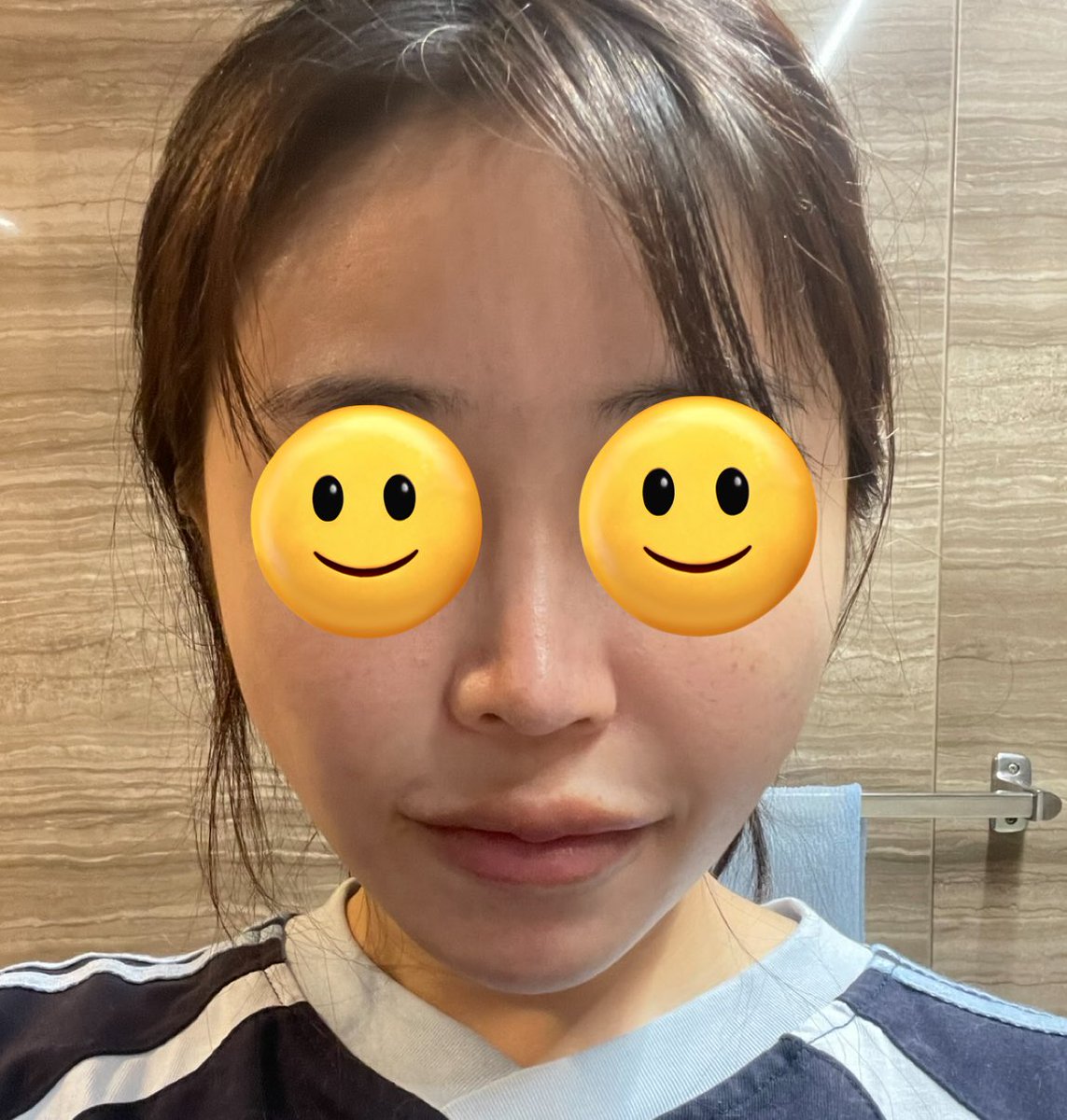 pearl_everyday's tweet photo. もう4回目のラポエルへ🏥
毎回本音レビューしていたら、今回は初めてモニターを勧めてもらってミント８本無料🙌😭✨あと追加料金払って、
ピンチノーズの改善のため2回目鼻フィラーもしてもらった✨余ったヒアルは貴族と顎に入れてもらいました😊
糸リフトは毎回最初の麻酔だけチクっと熱く感じて痛いけど、その後はやっぱり最後まで無痛で凄いしスピーディ。引き上がり具合も流石過ぎて文句無し。
術後は、表情を変える時にコメカミのところは痛いけど、口はちゃんと開くし問題なし、何も支障なくて嬉しい。
内出血も出なくて、1日経っても腫れてるのかわからない程度。
まずビフォーアフター⬇️