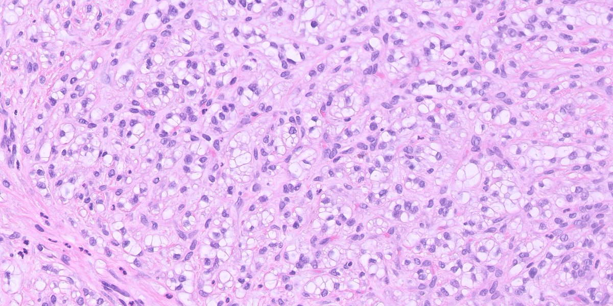 kis_lorand's tweet photo. 1/A challenging skin tumor for the New Year!!! 
Elderly patient with a nodular lesion on the neck, removed by shave excision.
I would appreciated your thoughts on this case 🙏
IHCs will follow in the thread 👇👇
@HENRYY_MD https://t.co/PtS1yxCOZM