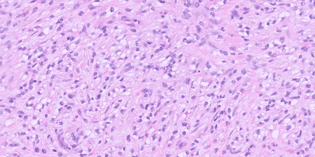 kis_lorand's tweet photo. 1/A challenging skin tumor for the New Year!!! 
Elderly patient with a nodular lesion on the neck, removed by shave excision.
I would appreciated your thoughts on this case 🙏
IHCs will follow in the thread 👇👇
@HENRYY_MD https://t.co/PtS1yxCOZM