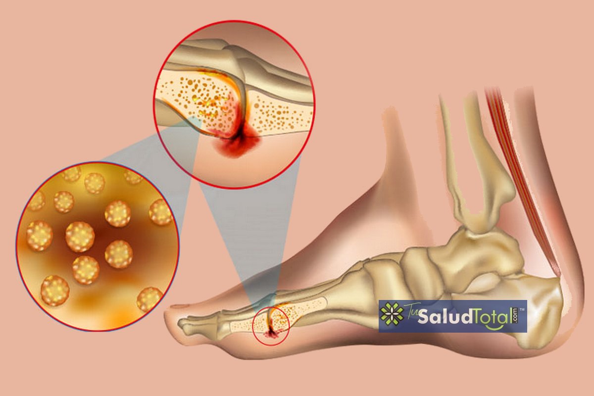 SaludTotal10's tweet photo. 🦴🔍 ¿Dolor en los huesos? Podría ser Osteomielitis
📚💉 ¿Sabías que esta infección ósea puede ser devastadora si no se trata a tiempo? 
🚑😱 Conoce sus causas, síntomas y tratamientos efectivos. 
💪🔥 Haz clic: 
https://t.co/dTruswm9ea

#SaludÓsea #Osteomielitis #CuidaTusHuesos https://t.co/72qQjK2uCQ