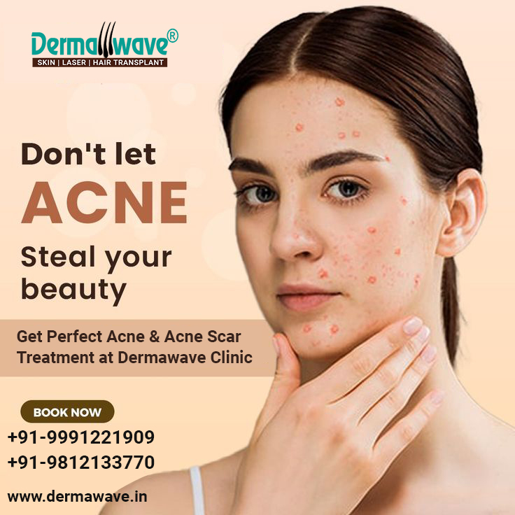 DermawaveHT's tweet photo. Dermawave Skin, Laser &amp; Hair Transplant Clinic
Concern Your Dermatologist for All types of Acne &amp; Acne Scars treatment.
https://t.co/hun3VE23UI | +91 99912 21909
#skindoctor #acne #acne #acnescars #pimples #facepimples #acneonface https://t.co/w3ZS5OTcgv