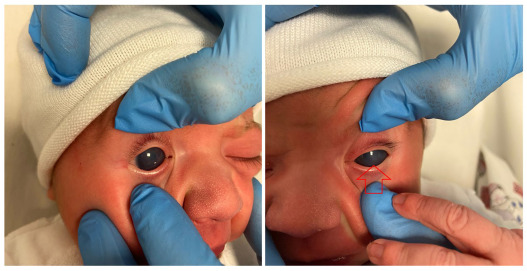 PediatricianJob's tweet photo. Bilateral Primary Congenital Glaucoma in a Newborn https://t.co/s2mxqJ4AFH https://t.co/Bu7LqB1v4H