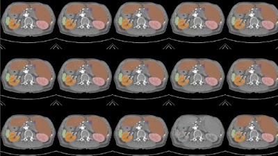 Radiology_AI's tweet photo. Can the computational effort of 3D CT-based multiorgan segmentation with TotalSegmentator be reduced via Tucker decomposition-based network compression? https://t.co/Sd4DqGhUk8 @LMU_Radiology #TotalSegmentator #RadCT #AI https://t.co/iWrxLWrrdp