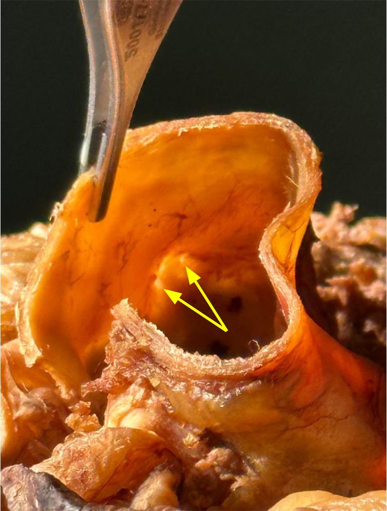 Annals of Internal Medicine: Clinical Cases (@annalsofimcc) on Twitter photo Double Right Coronary Artery Originating From Separate Ostia in an Older Female Cadaver With Cerebrovascular Disease. Full text of this case report from <a href="/vcomvirginia/">VCOM-Virginia</a> is freely available at bit.ly/4jkfMT4. <a href="/Annalsofim/">Annals of Int Med</a> <a href="/ACPIMphysicians/">ACP</a> <a href="/AHAScience/">AHA Science</a> #AHAjournals Double Right Coronary Artery Originating From Separate Ostia in an Older Female Cadaver With Cerebrovascular Disease. Full text of this case report from <a href="/vcomvirginia/">VCOM-Virginia</a> is freely available at bit.ly/4jkfMT4. <a href="/Annalsofim/">Annals of Int Med</a> <a href="/ACPIMphysicians/">ACP</a> <a href="/AHAScience/">AHA Science</a> #AHAjournals