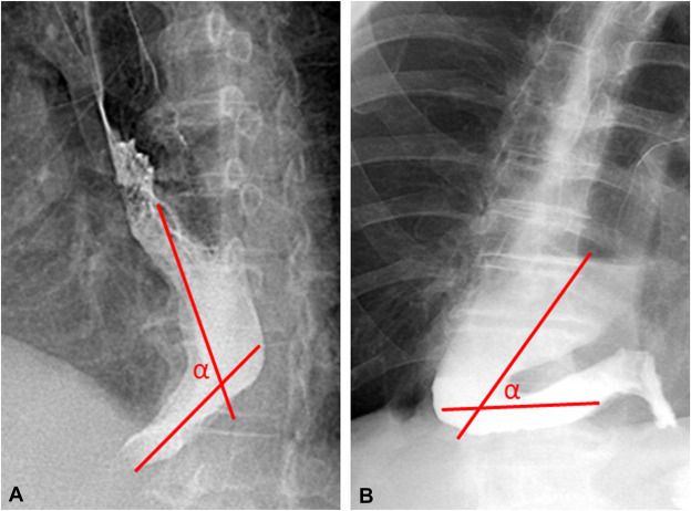 GIE (@gie_journal) on Twitter photo In GIEās Articles in Press: "Short esophageal myotomy versus standard myotomy for treatment of sigmoid-type achalasia: results of an international multicenter study" by Eric Swei et al. giejournal.org/article/S0016-ā¦
<a href="/prashantkediamd/">Prashant Kedia MD, FACG, FASGE</a> <a href="/RishiPawa/">Rishi Pawa</a> <a href="/PugaTejada/">Miguel Angel Puga Tejada</a> <a href="/carlosoakm/">Carlos Robles-Medranda, MD, FASGE, AGAF</a> <a href="/MouenKhashab/">Mouen Khashab, MD, MASGE</a> In GIEās Articles in Press: "Short esophageal myotomy versus standard myotomy for treatment of sigmoid-type achalasia: results of an international multicenter study" by Eric Swei et al. giejournal.org/article/S0016-ā¦
<a href="/prashantkediamd/">Prashant Kedia MD, FACG, FASGE</a> <a href="/RishiPawa/">Rishi Pawa</a> <a href="/PugaTejada/">Miguel Angel Puga Tejada</a> <a href="/carlosoakm/">Carlos Robles-Medranda, MD, FASGE, AGAF</a> <a href="/MouenKhashab/">Mouen Khashab, MD, MASGE</a>