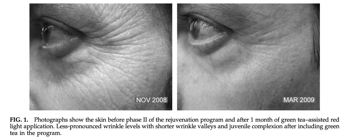 BioavailableNd's tweet photo. Green Tea and Red Light: my new N=1. 
Rejuvenated skin, reduced wrinkle levels, and juvenile complexion, previously realized in 10 months of light treatment alone were realized in 1 month with green tea + red light. 

 "we filled cotton pads with green tea (concentration, 3 g dry leaf mass per 250 mL of water; brewing temperature, 100C; cooling time, 30 min) and placed them for 20 min onto the skin around the corner of the eyes before irradiating the wrinkled zones directly according to the protocol"
