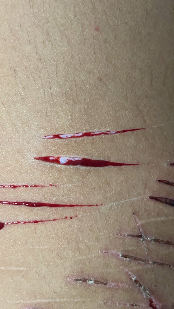 Ticcitoby__irl's tweet photo. HAHAHAHAHAHAHAHAHAHAHA IM GONNA TWEAK OUT SO BAD WHY IS MY PAIN TOLERANCE SO BAF HAHAHAHAAHGA I JUSY WANT FO HIT BEANS PLSLPLSPLSPLSPLSPLS HAHAHAHAHAHAH #smallbeans #babybeans #deepstyros https://t.co/PAGS8oYZeo
