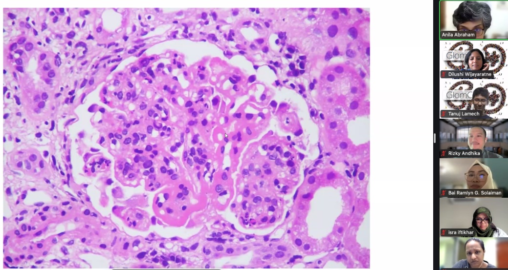 Dilushiwijay's tweet photo. Wire loops, mesangial hyepcellularity, endocapillary hypercellularity, hyaline thrombi.... #lupus

 @AnilaKurien makes pictures speak >1000 words at @GlomCon fellowship #podocin https://t.co/70DFaJOxl7