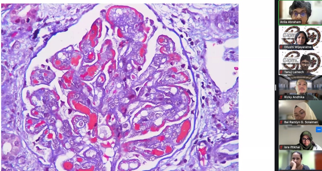 Dilushiwijay's tweet photo. Wire loops, mesangial hyepcellularity, endocapillary hypercellularity, hyaline thrombi.... #lupus

 @AnilaKurien makes pictures speak >1000 words at @GlomCon fellowship #podocin https://t.co/70DFaJOxl7