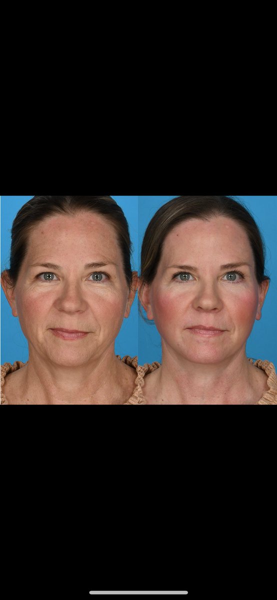 DrRodRohrich's tweet photo. #facelft finesse https://t.co/4yq7wgzS7z