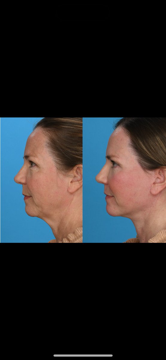 DrRodRohrich's tweet photo. #facelft finesse https://t.co/4yq7wgzS7z