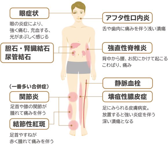 この前に血尿が出たけど、原因は「結石」だった🪨

潰瘍性大腸炎の合併症に、結石が入ってる‥‥なりやすいのね。
皆さんもお気をつけて◎
