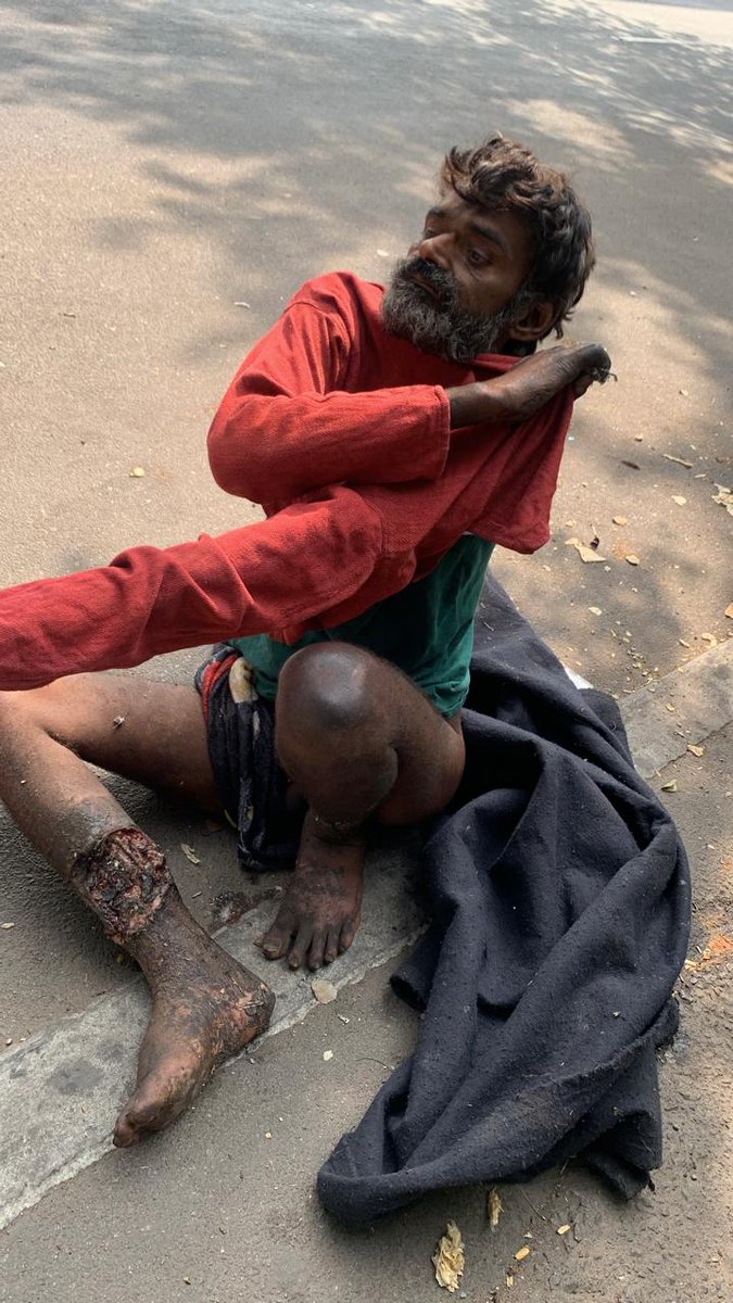 GoodSamaritanIn's tweet photo. Request to help this aged man was unable to move with injury with maggots. Last 1 week, he has been there Asembly Metro station. Pillar No 259. Thank you, @shonampally @GHMCOnline @DeccanChronicle @TelanganaCMO @CommissionrGHMC @gadwalvijayainc @hydcitypolice @Collector_HYD https://t.co/byafCT25Y2