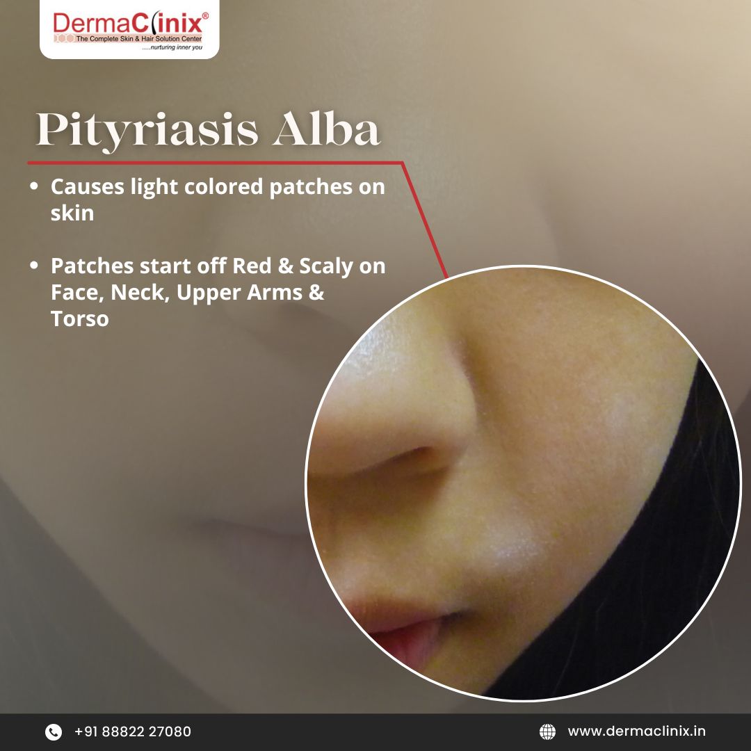 dermaclinix_dl's tweet photo. Ever wondered what that white patch is? 
Vitiligo? 

Maybe yes or maybe it is something else. Let's explore together
Book your consultation today.

Call/WhatsApp us at +91 8882227080 

For more, visit: https://t.co/xURMDZLUK9

 #YouthfulSkin #SkinCareSecrets #DermaClinix https://t.co/cAj9FLERwX