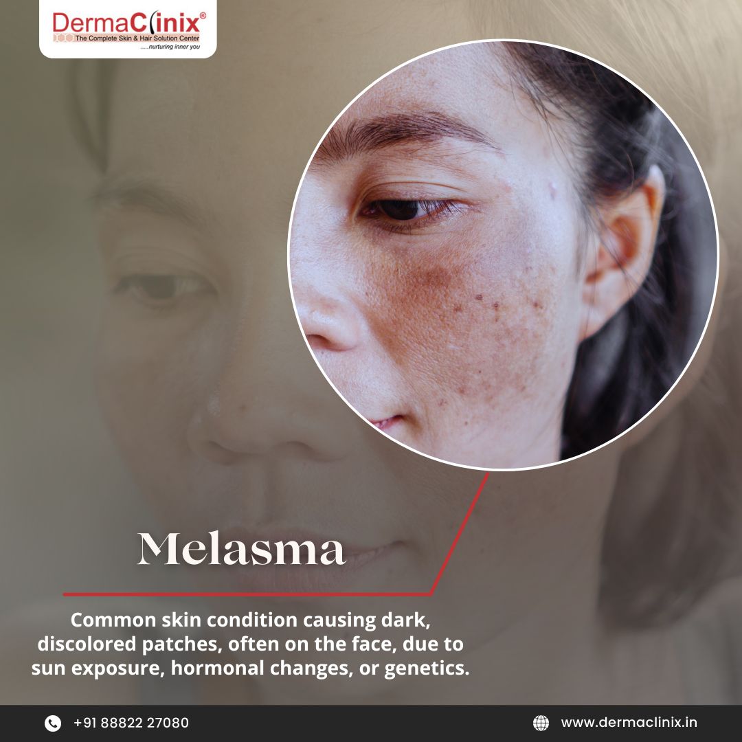 dr_kavish's tweet photo. Ever wondered what that white patch is? 
Vitiligo? 

Maybe yes or maybe it is something else. Let's explore together
Book your consultation today.

Call/WhatsApp us at +91 8882227080 

For more, visit: https://t.co/fE8Nj139nS

 #YouthfulSkin #SkinCareSecrets #DermaClinix https://t.co/jLRnfPYvWx