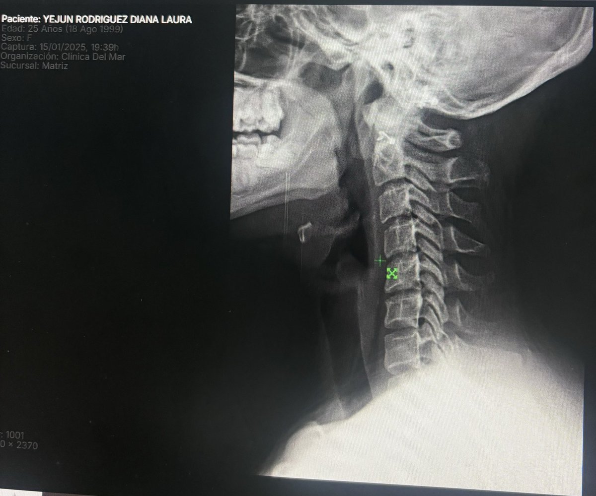 dianayejunr's tweet photo. Mi mayor miedo siempre a sido manejar, y justo la primer semana que me animé a agarrar el carro para llevármelo al trabajo, me chocan y traigo un esguince cervical  😭😭 https://t.co/NtKrYZ3aOq