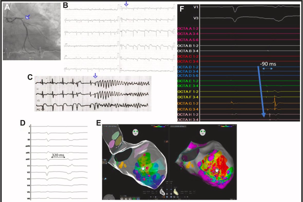 ramos__maqueda's tweet photo. Ultra-High-Density Catheter Ablation of Purkinje Premature Ventricular Contractions Causing Electrical Storm | JACC: Case Reports https://t.co/OCLcxYwrfp

Congrats to @Pvadillo_95 in @ArritmiasHCUZ, it was a challenging but very beautiful case! #EPeeps https://t.co/MhqHCuA0Lk