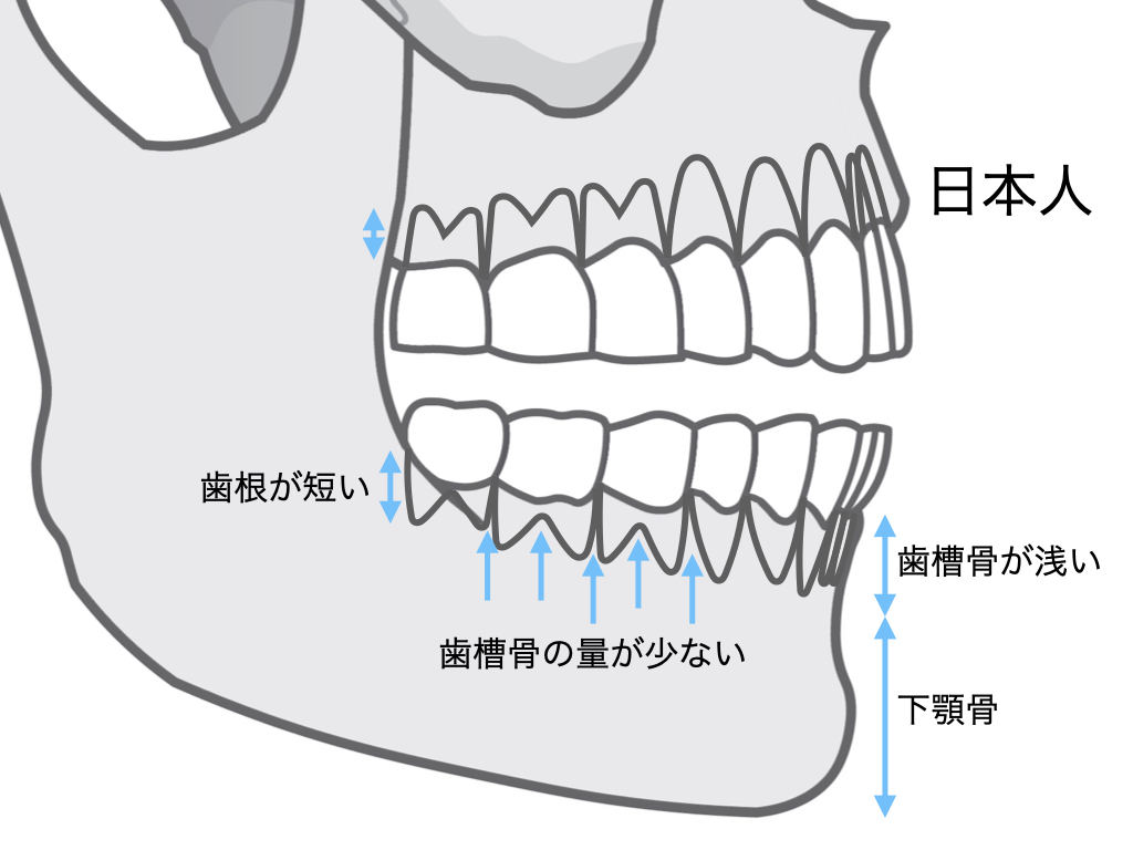 shira_ortho's tweet photo. 日本人は白人系よりも
①歯根の長さが短い
②歯根間距離が狭くて歯槽骨の量が少ない
③歯槽骨が浅い
なので日本人の歯を長持ちさせるには白人のマネの歯科医療では「雑」すぎます。
矯正は必須だししかも日本人向けの繊細で丁寧な矯正治療が必要です。 https://t.co/e6wBih7o9L