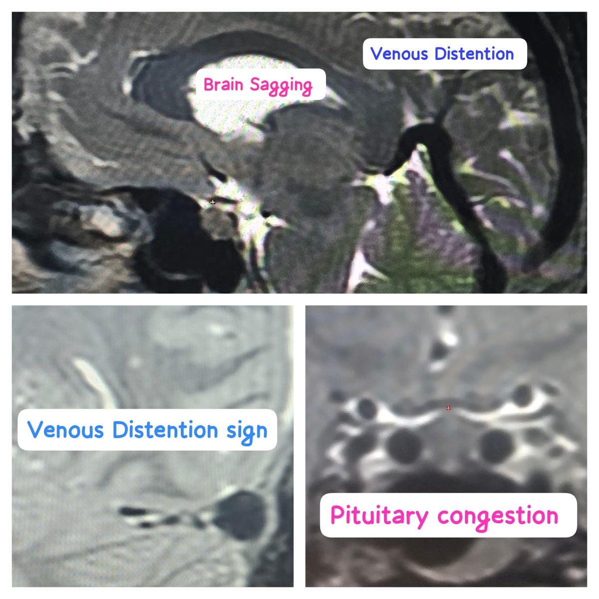 SharathKumarGG7's tweet image. Patient no. 50, Type1A Spinal CSF leak. Bedbound since 6 weeks [3 weeks undiagnosed &amp;amp; 3 weeks conservative trial after diagnosing]..worsened &amp;amp; got admitted with us. Targeted EBP with 12ml autologous blood &amp;amp; symptoms disappear @ApolloKarnataka #SIH #SpinalCSFleak #Headache…