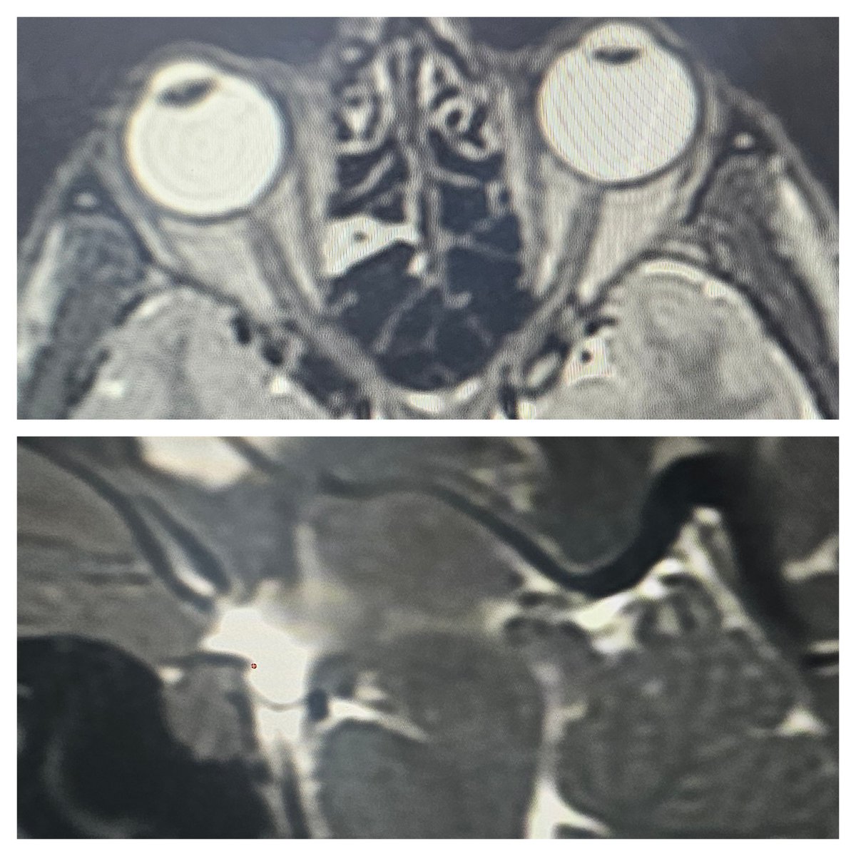 SharathKumarGG7's tweet image. Patient no. 50, Type1A Spinal CSF leak. Bedbound since 6 weeks [3 weeks undiagnosed &amp;amp; 3 weeks conservative trial after diagnosing]..worsened &amp;amp; got admitted with us. Targeted EBP with 12ml autologous blood &amp;amp; symptoms disappear @ApolloKarnataka #SIH #SpinalCSFleak #Headache…