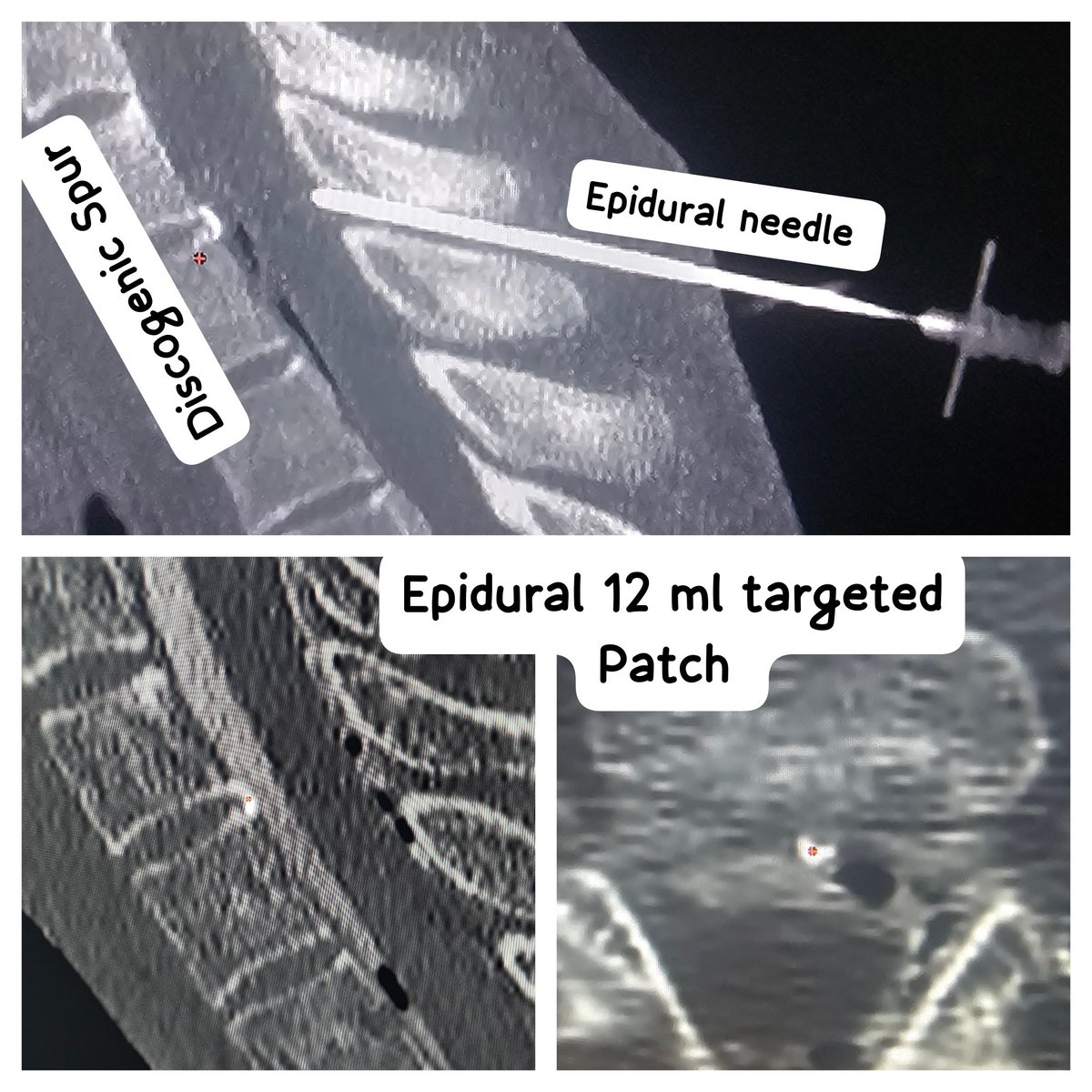 SharathKumarGG7's tweet image. Patient no. 50, Type1A Spinal CSF leak. Bedbound since 6 weeks [3 weeks undiagnosed &amp;amp; 3 weeks conservative trial after diagnosing]..worsened &amp;amp; got admitted with us. Targeted EBP with 12ml autologous blood &amp;amp; symptoms disappear @ApolloKarnataka #SIH #SpinalCSFleak #Headache…