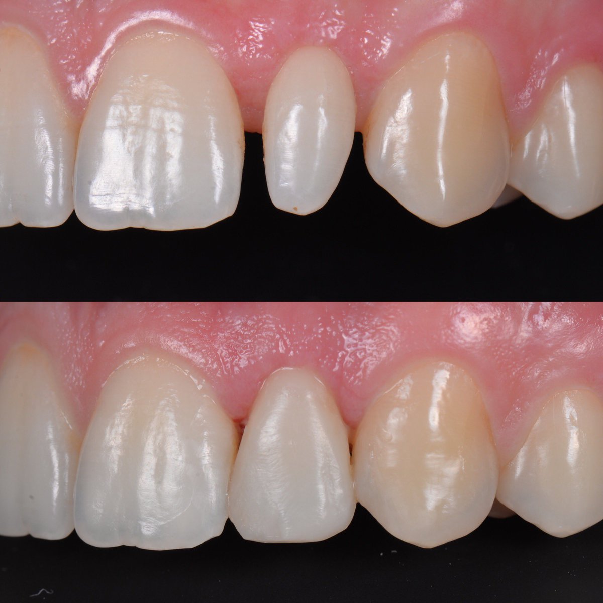 hakancolakdds's tweet image. Closing diastema with direct composite #directcomposite #estetikdişhekimliği