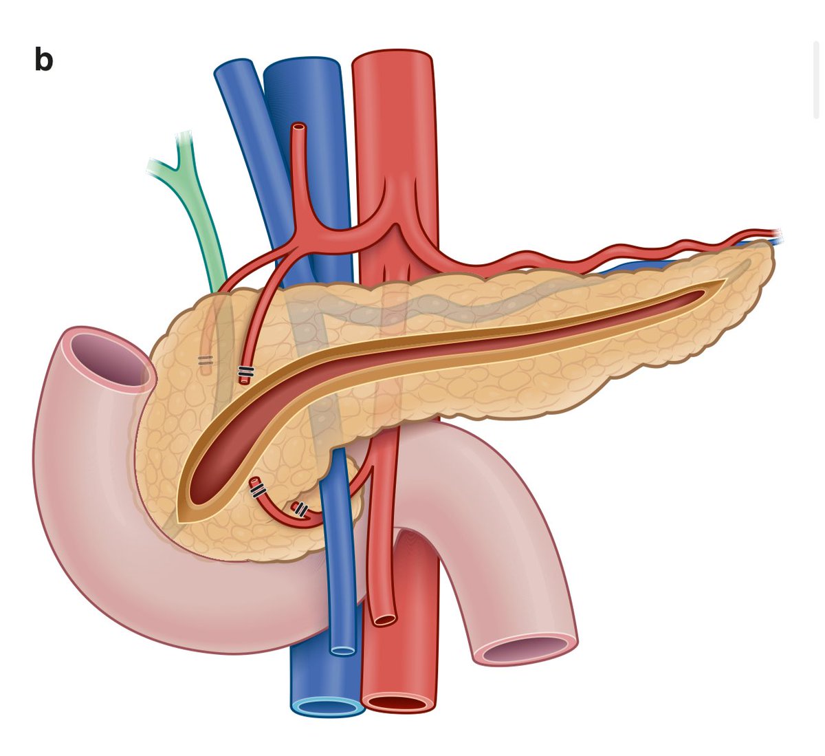 Marc Besselink (@marcbesselink) on Twitter photo Surgery for symptomatic wide duct #chronic #pancreatitis : 🔪or 🤖 ?
Today in <a href="/BjsOpen/">BJS Open</a> by <a href="/RM_Montorsi/">Roberto Maria Montorsi</a> <a href="/MichielFrancken/">Michiel Francken</a> <a href="/safesurg/">Marja Boermeester</a>
“This systematic review suggested that minimally invasive LPJ can be performed safely in … chronic pancreatitis. Phase 2 RCTs should assess Surgery for symptomatic wide duct #chronic #pancreatitis : 🔪or 🤖 ?
Today in <a href="/BjsOpen/">BJS Open</a> by <a href="/RM_Montorsi/">Roberto Maria Montorsi</a> <a href="/MichielFrancken/">Michiel Francken</a> <a href="/safesurg/">Marja Boermeester</a>
“This systematic review suggested that minimally invasive LPJ can be performed safely in … chronic pancreatitis. Phase 2 RCTs should assess