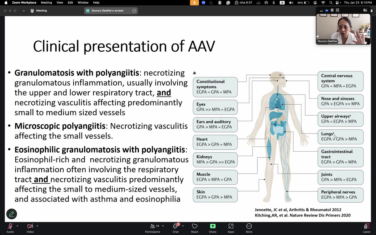 Mohamed H. Hassanein | محمد هشام حسنين 🇪🇬 (@kidneymo) on Twitter photo Thrilled to learn about the latest updates in ANCA-associated vasculitis from the phenomenal educator, researcher and expert: <a href="/DuvuruG/">Duvuru Geetha</a> <a href="/GlomCon/">GlomCon</a> today!
<a href="/BetterCallSeeth/">Harish Seethapathy</a> Thrilled to learn about the latest updates in ANCA-associated vasculitis from the phenomenal educator, researcher and expert: <a href="/DuvuruG/">Duvuru Geetha</a> <a href="/GlomCon/">GlomCon</a> today!
<a href="/BetterCallSeeth/">Harish Seethapathy</a>