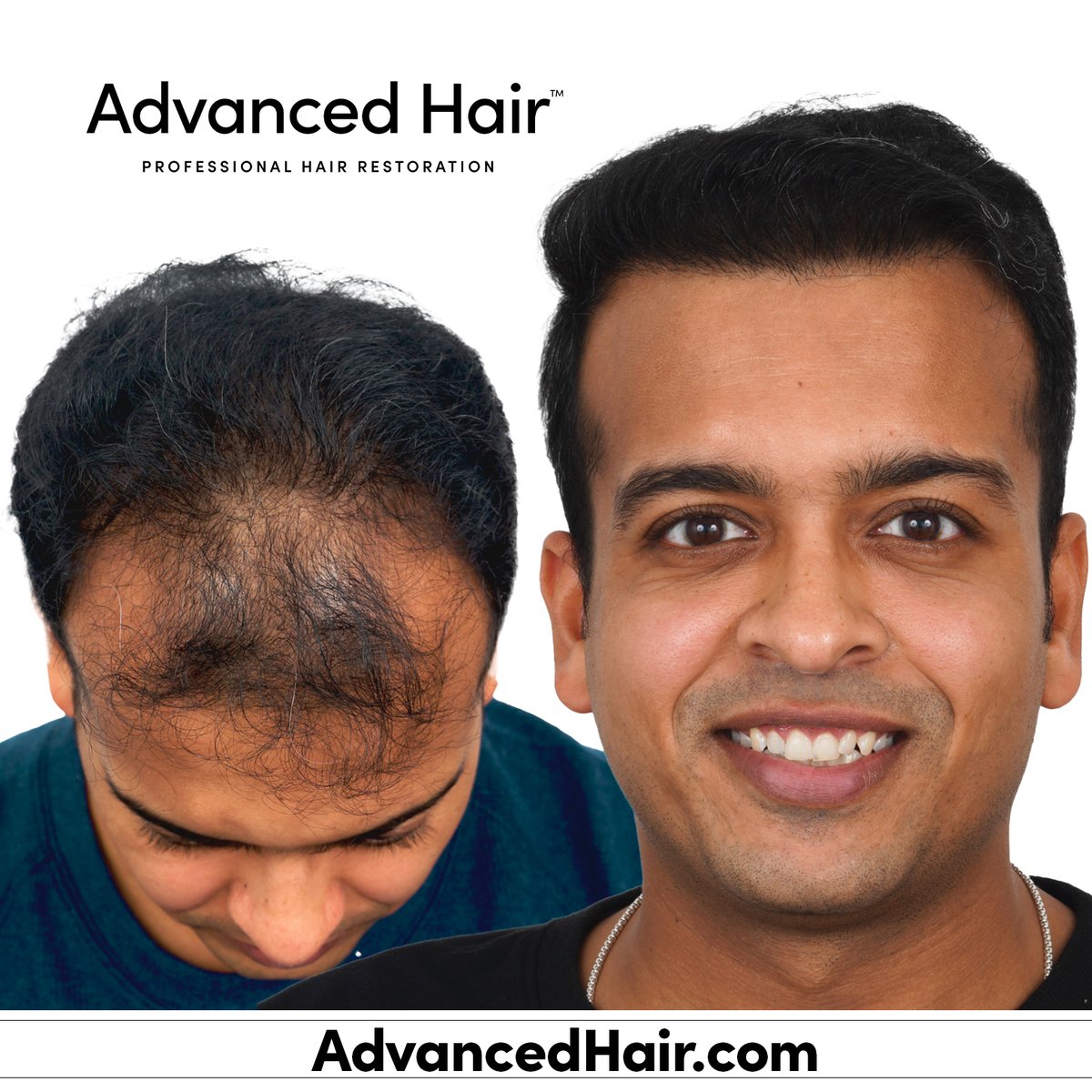 GoAdvancedHair's tweet photo. 🥼Rediscover Your Confidence with Advanced FUE® Hair Transplants🏅

     Are you tired of hiding thinning areas or feeling self-conscious about hair loss? Our FUE (Follicular Unit Extraction) technique offers a simple way to restore your natural look with only one day in our office—so you can get back to feeling like yourself again. 

Don’t wait another day to take control of your confidence.⌛

   Click or copy the link - https://t.co/tD6y3hu8hz or go to https://t.co/n447DaqHf3 now and book your free consultation to learn how FUE can transform your hair and your life.

#FUEHairTransplant #HairLossSolution #HairRestoration #AdvancedHair #ConfidenceBoost #HairRegrowth #FreeConsultation