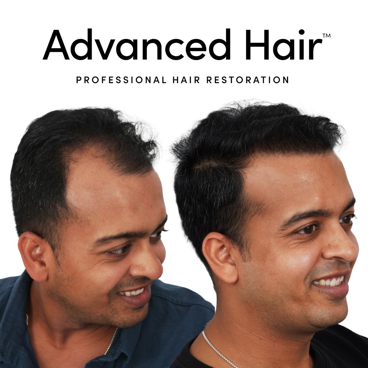 GoAdvancedHair's tweet photo. 🥼Rediscover Your Confidence with Advanced FUE® Hair Transplants🏅

     Are you tired of hiding thinning areas or feeling self-conscious about hair loss? Our FUE (Follicular Unit Extraction) technique offers a simple way to restore your natural look with only one day in our office—so you can get back to feeling like yourself again. 

Don’t wait another day to take control of your confidence.⌛

   Click or copy the link - https://t.co/tD6y3hu8hz or go to https://t.co/n447DaqHf3 now and book your free consultation to learn how FUE can transform your hair and your life.

#FUEHairTransplant #HairLossSolution #HairRestoration #AdvancedHair #ConfidenceBoost #HairRegrowth #FreeConsultation