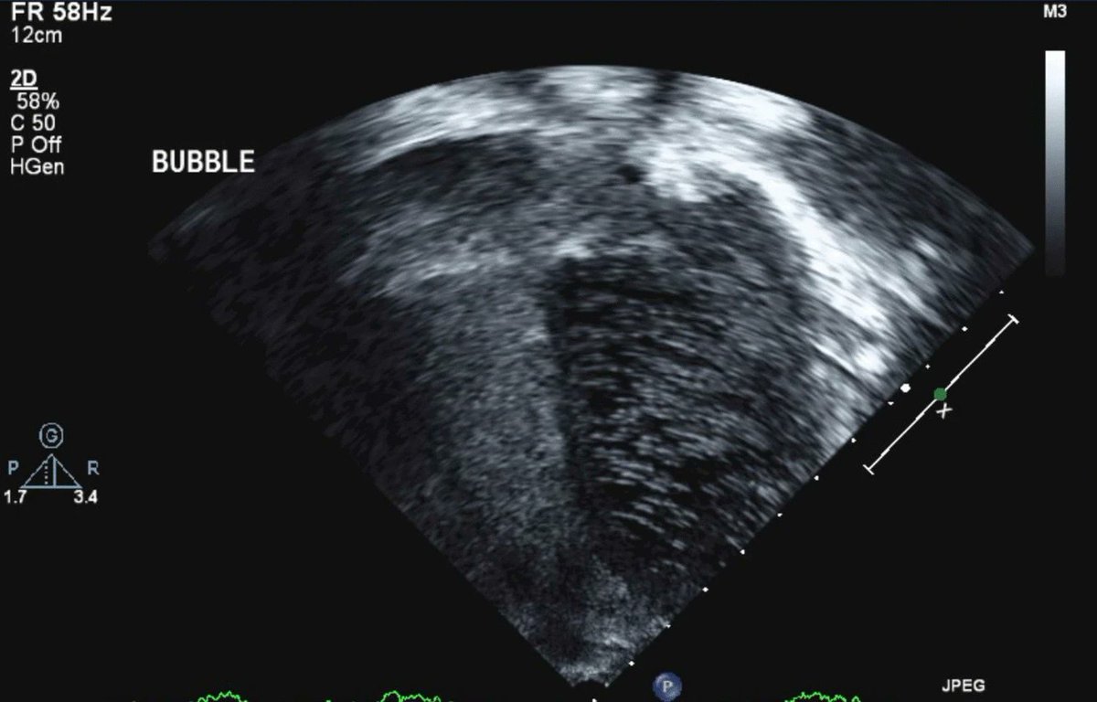 Hepatopulmonary syndrome (HPS) is a life-threatening complication of chronic liver disease. Some children w/kidney disease have coexistent CLD &amp; are at risk of HPS. Read this Original Article on HPS assoc w/autosomal recessive polycystic kidney disease.
link.springer.com/article/10.100…
