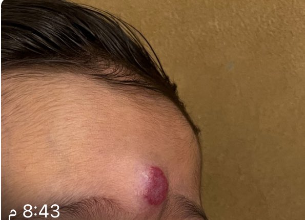 من يفيدنا عن علاج الحبة التي في وجه الطفل ؟