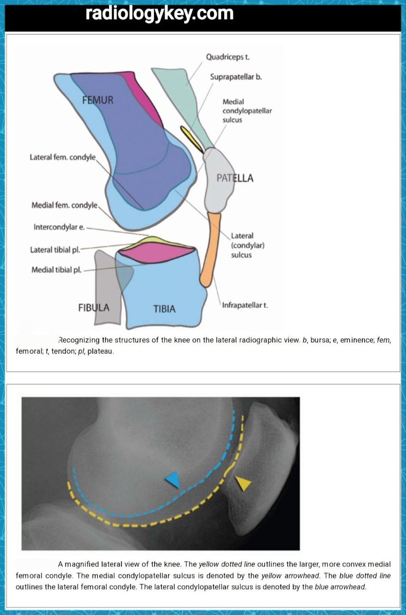 OBandarchi's tweet photo. 🛑It's imperative to know the structures of knee in detail on the lateral radiograph in order not to miss any pathology..... 
For example pay close attention to Lateral vs  Medial Condylopatellar sulci..etc https://t.co/vyuCMBzp0q