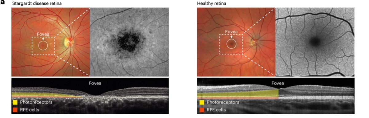 Michael F. Chiang, MD (@neidirector) on Twitter photo High-efficiency base editing to treat #Stargardt disease looks promising in primates and human tissue #organoids.
<a href="/UniBasel_en/">University of Basel</a>
<a href="/NatureMedicine/">Nature Medicine</a>: go.nature.com/4gFHJ6h High-efficiency base editing to treat #Stargardt disease looks promising in primates and human tissue #organoids.
<a href="/UniBasel_en/">University of Basel</a>
<a href="/NatureMedicine/">Nature Medicine</a>: go.nature.com/4gFHJ6h