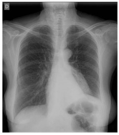 🤔 Caso clínico MIR:
Mujer de 58 años con un cuadro de meses de evolución de tos, odinofagia y carraspeo, que consula por presentar esputos hemoptoicos. No refiere fiebre ni disnea. Exfumadora hace más de 30 años (fumó durante 10 años 1paq/día). La analítica es normal. Se muestra
