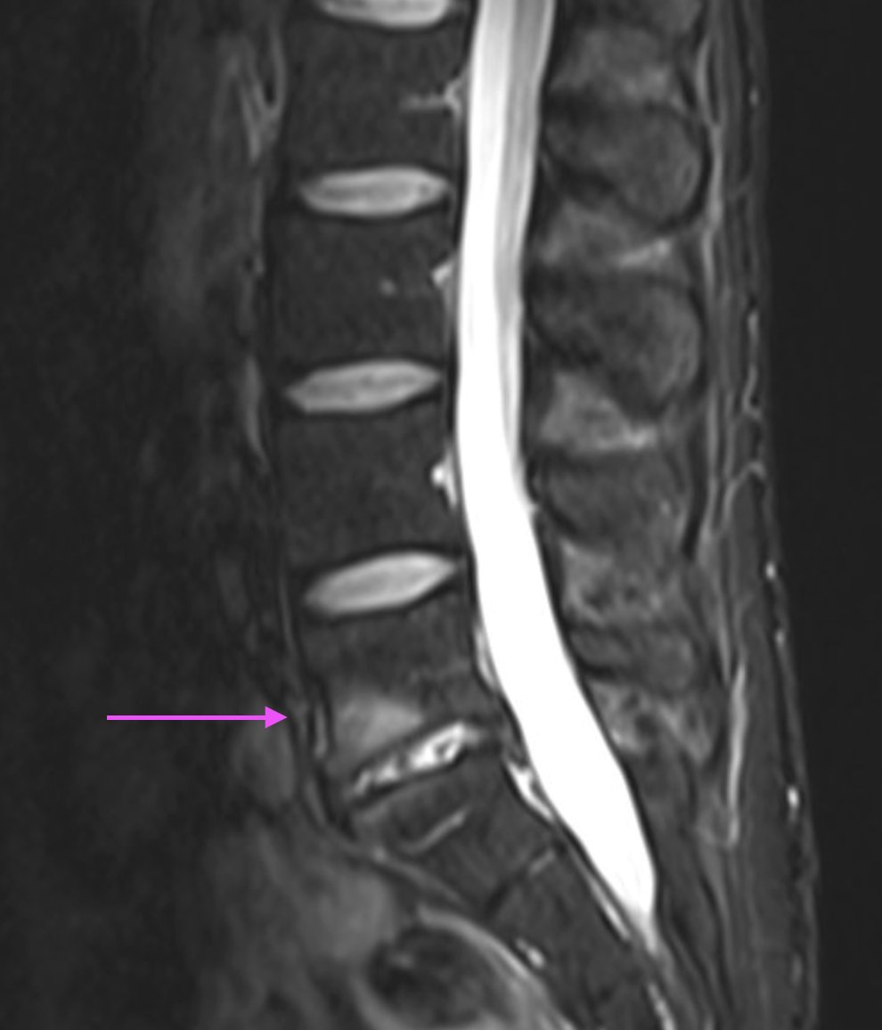 Modic changes on lumbar MRI can be related to low back pain and can help inform the diagnosis and management of a range of conditions. 

What do they mean? When might they matter? And which MRI sequences best illustrate them? A 🧵for MSK clinicians &amp; physios. 👇 1/12